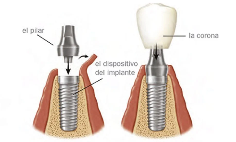partes de un implante dental