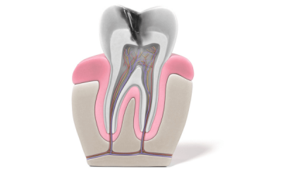 ¿Qué es una endodoncia dental?