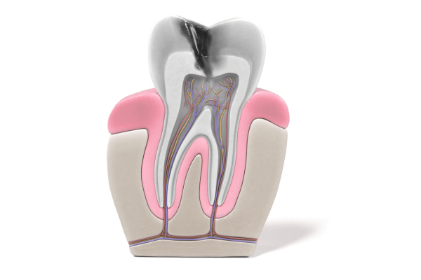 endodoncia_dental_blog_clínica_dental_irene_Aroca
