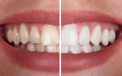 Manchas en los dientes: por qué aparecen y cómo eliminarlas