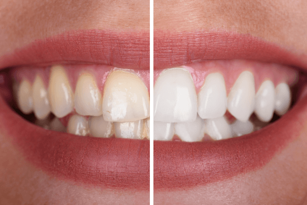 Blog_Manchas_dentales