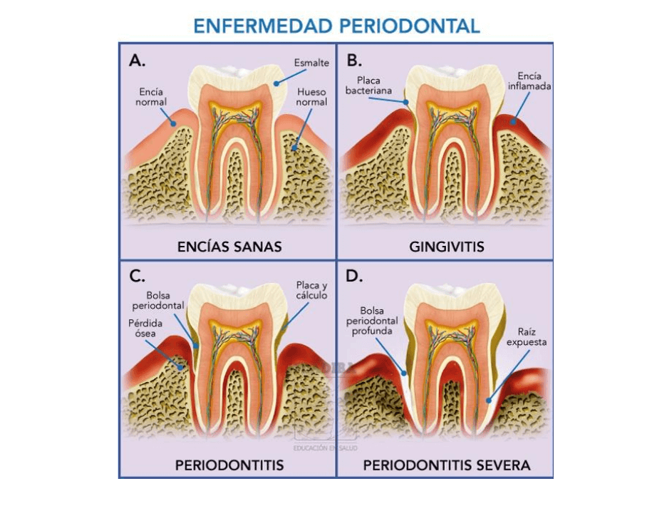 Etapas de la enfermedad de las encías (gingivitis y periodontitis)