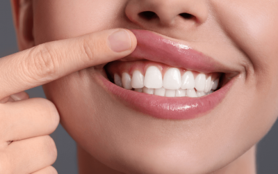 Gingivitis y Periodontitis