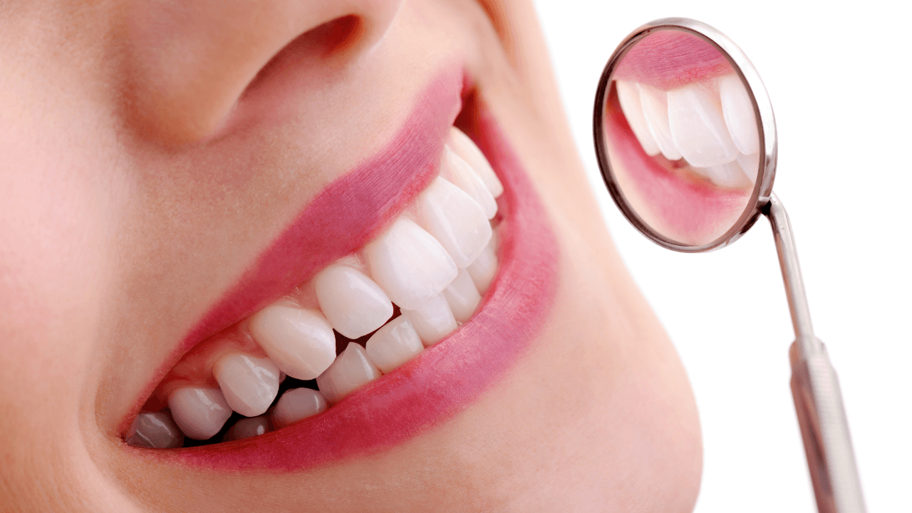 blog- carillas-dentales