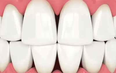 ¿Qué son los triángulos negros entre los dientes?