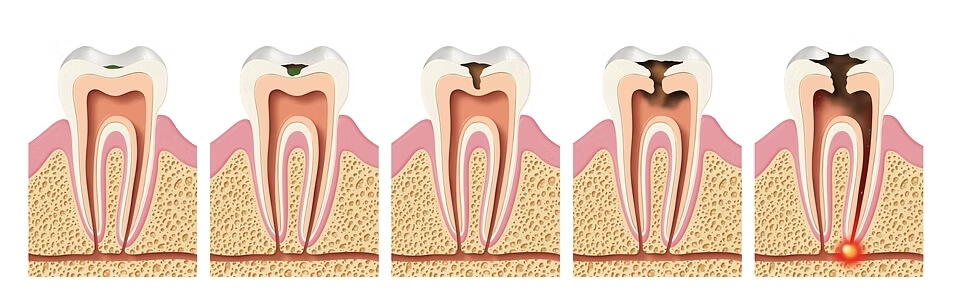 Irene Aroca Caries Dental 02