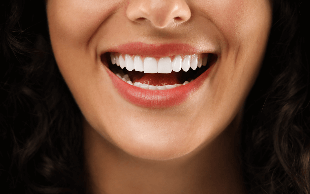 carillas firstfit clinica irene gonzalez merida 01