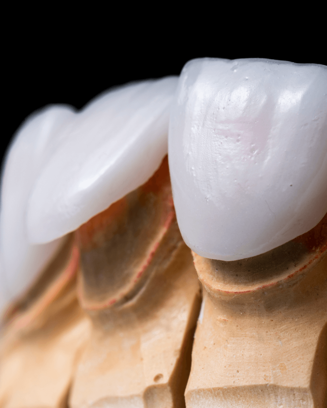 carillas firstfit clinica irene gonzalez merida 03