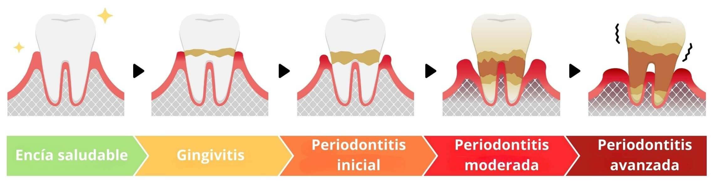Etapas de la periodontitis Clinica Dental Irene González Aroca