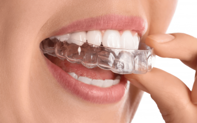 Ortodoncia Invisible en Mérida: Corregir tus dientes sin «hierros» es posible a cualquier edad