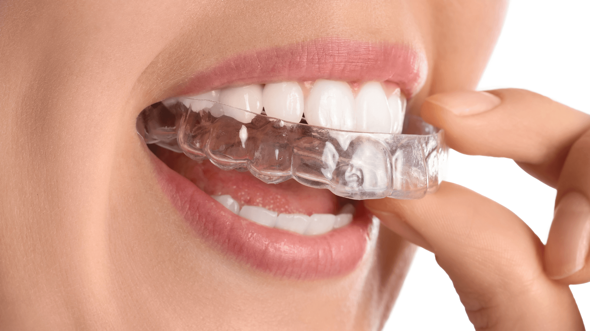 Paciente adulta sonriendo con alineadores de ortodoncia invisible en Clínica Irene González Aroca en Mérida