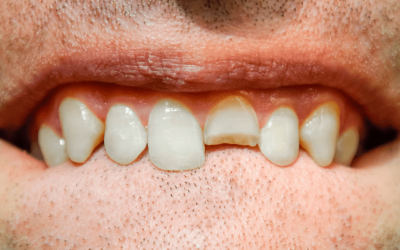 Se me ha roto un diente: Qué hacer al momento y cómo lo solucionamos en Mérida