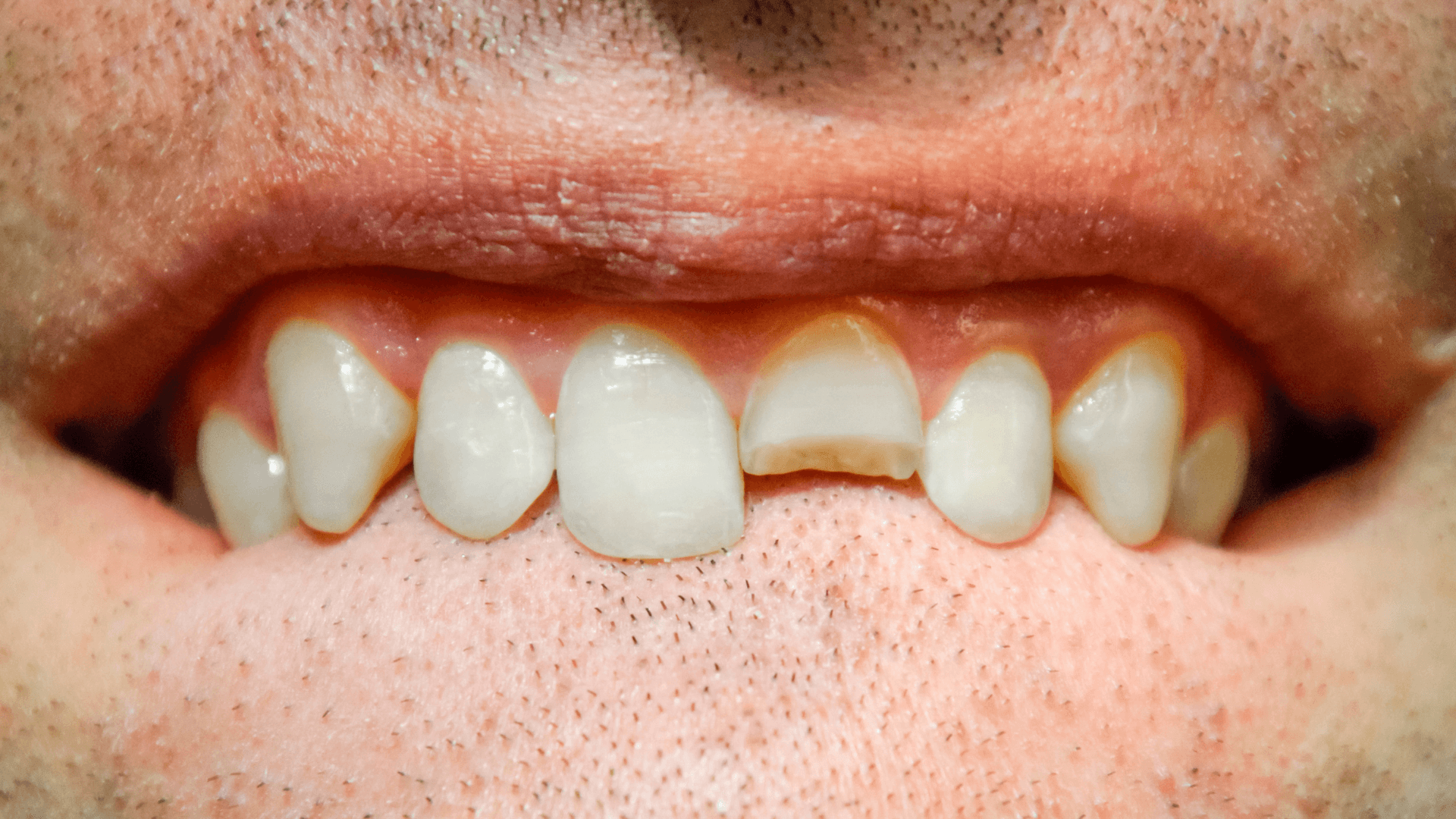 Plano de detalle extremo de un diente delantero delantero superior astillado de un hombre, mostrando la necesidad de una reparación dental estética en Mérida.