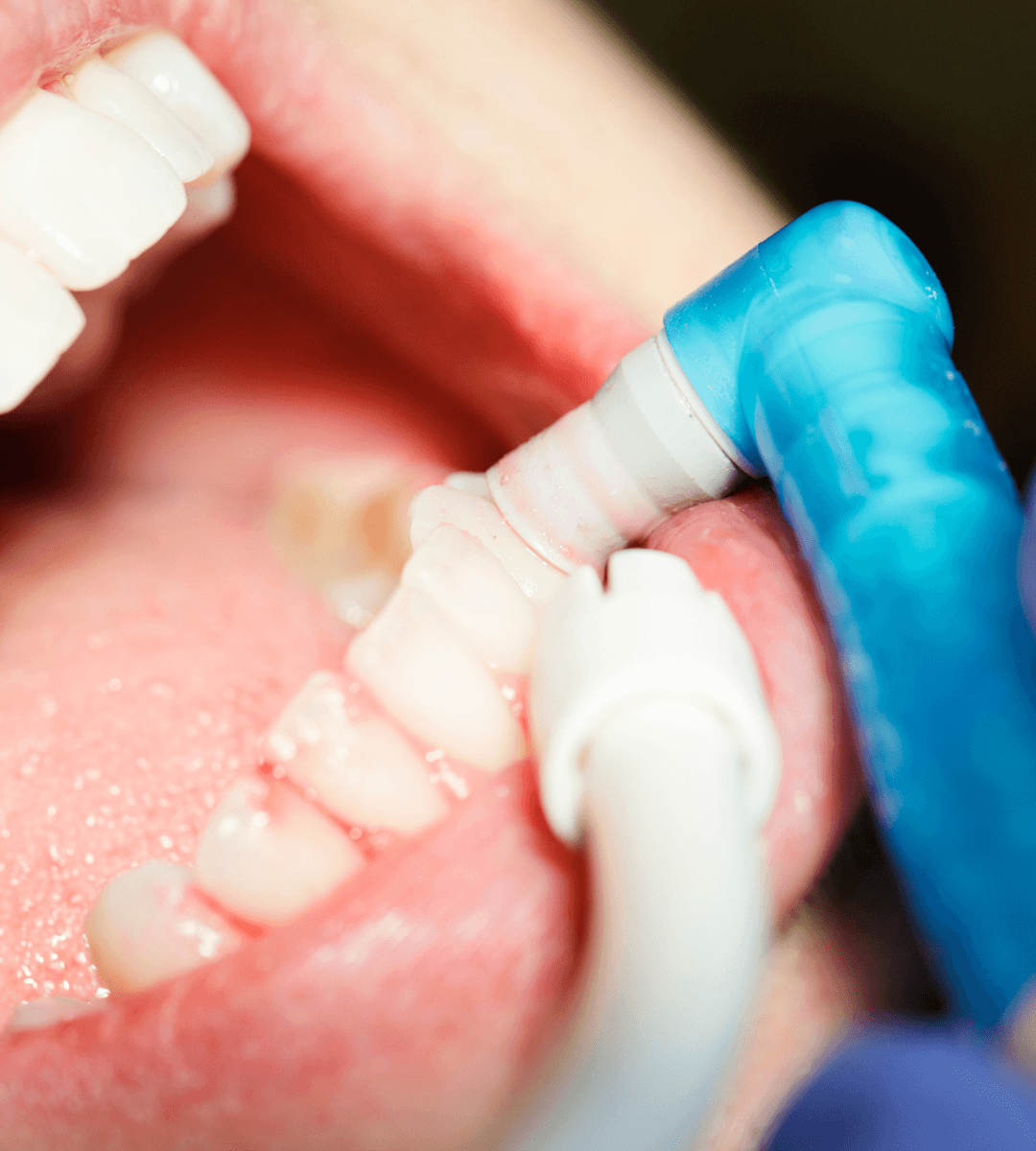 Higiene dental profesional para eliminar placa y sarro