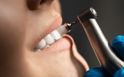 Limpieza dental profesional: cada cuánto hacerla y por qué es tan importante