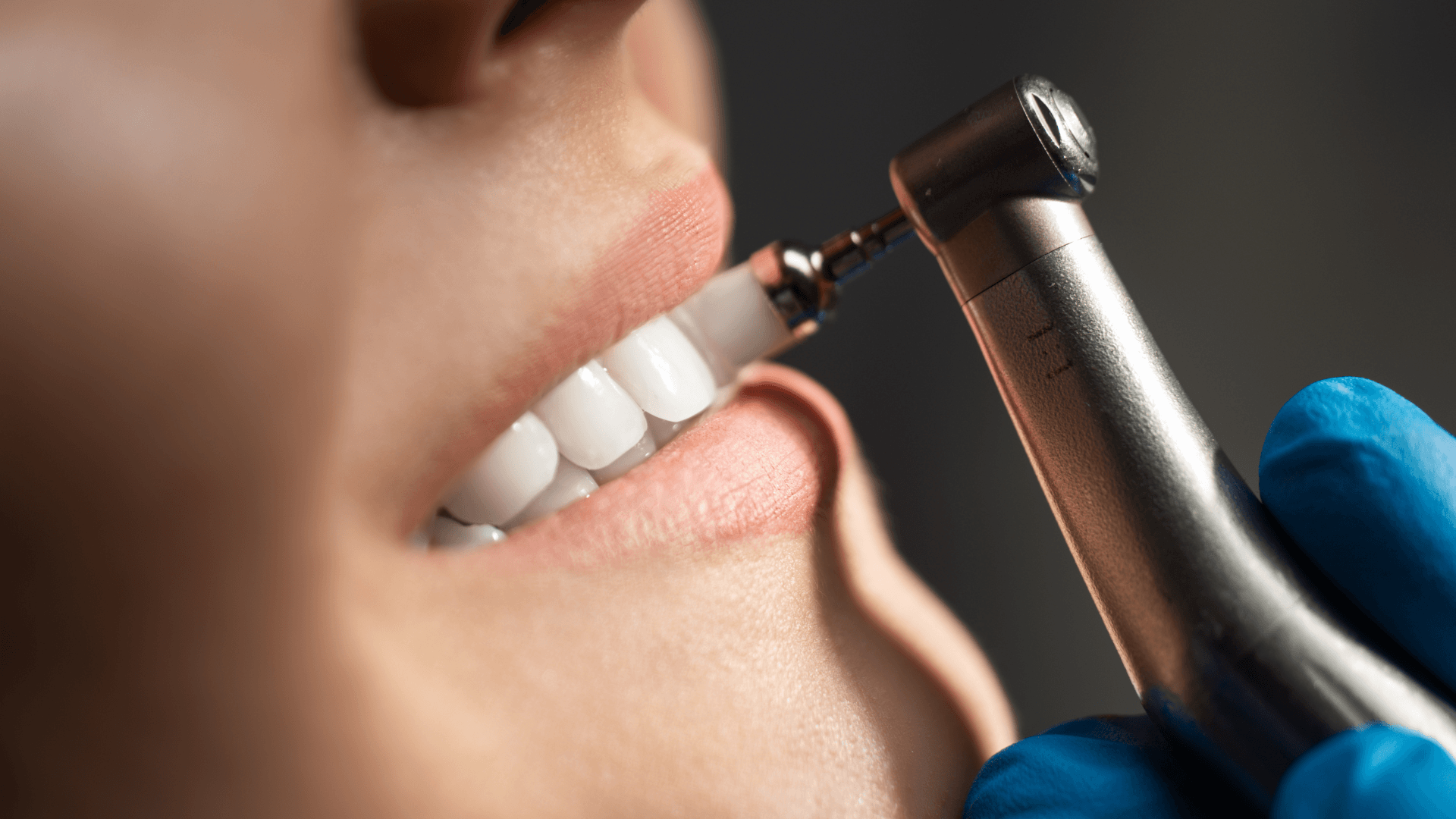 Limpieza dental profesional en clínica dental en Mérida
